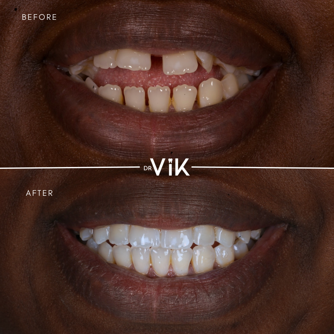 Invisalign case result