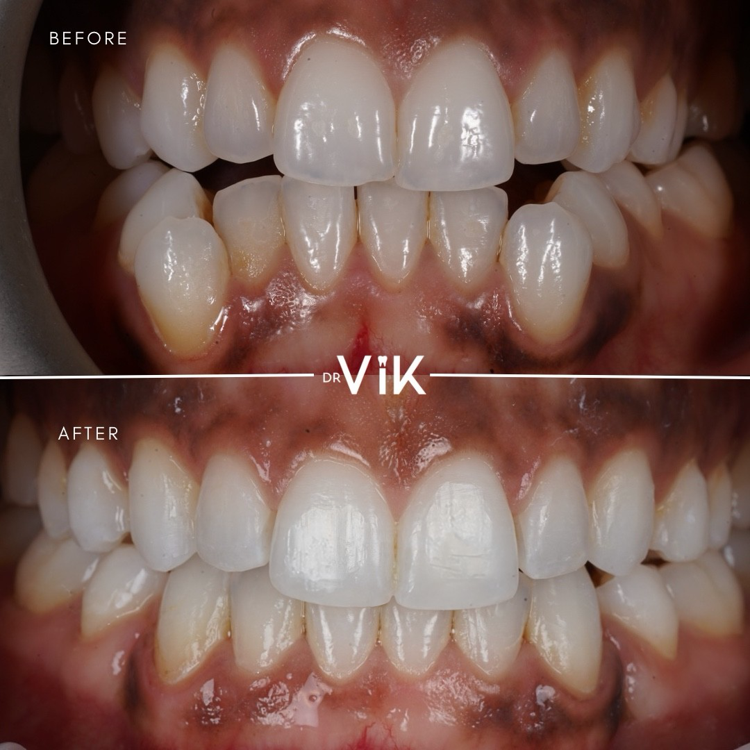 Invisalign case 10