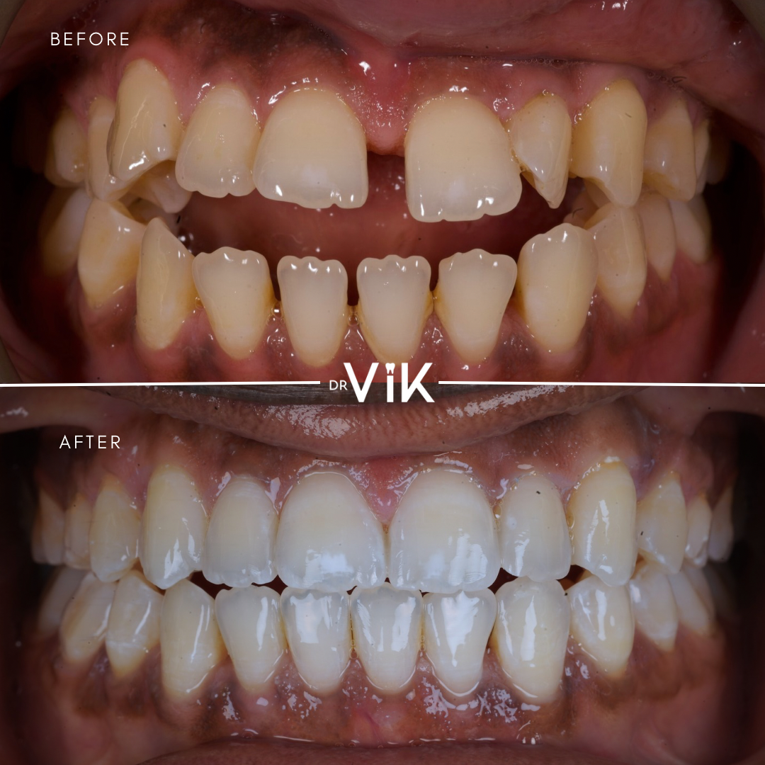 Invisalign alignment case
