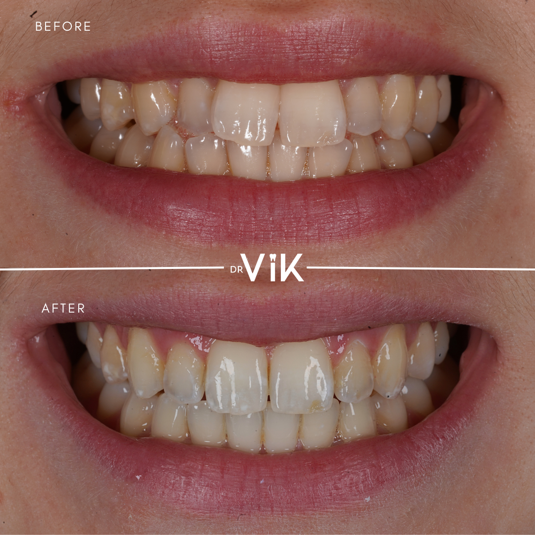 Invisalign spacing improvement