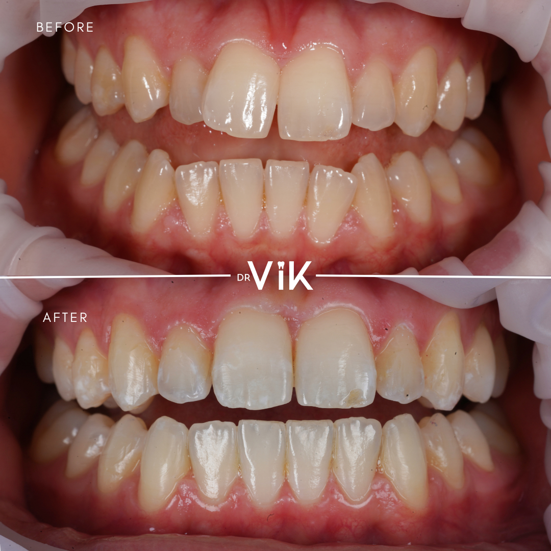 Invisalign planning outcome