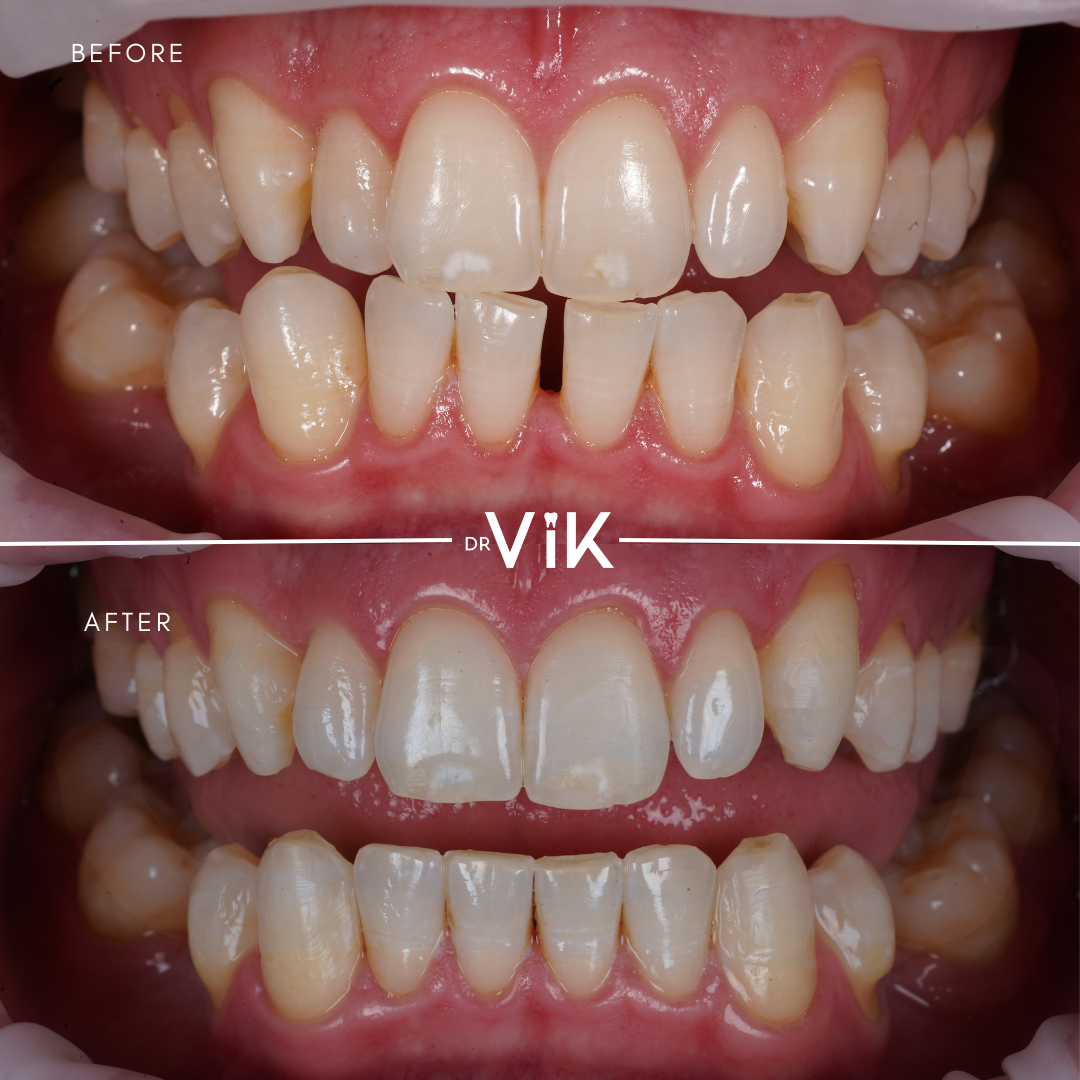 Invisalign case 6