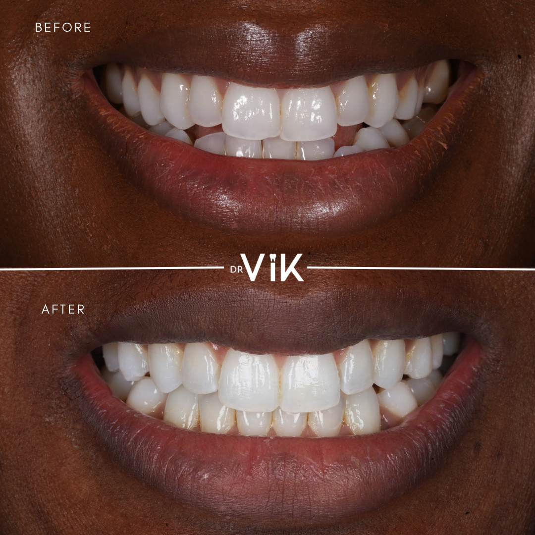 Invisalign case 8
