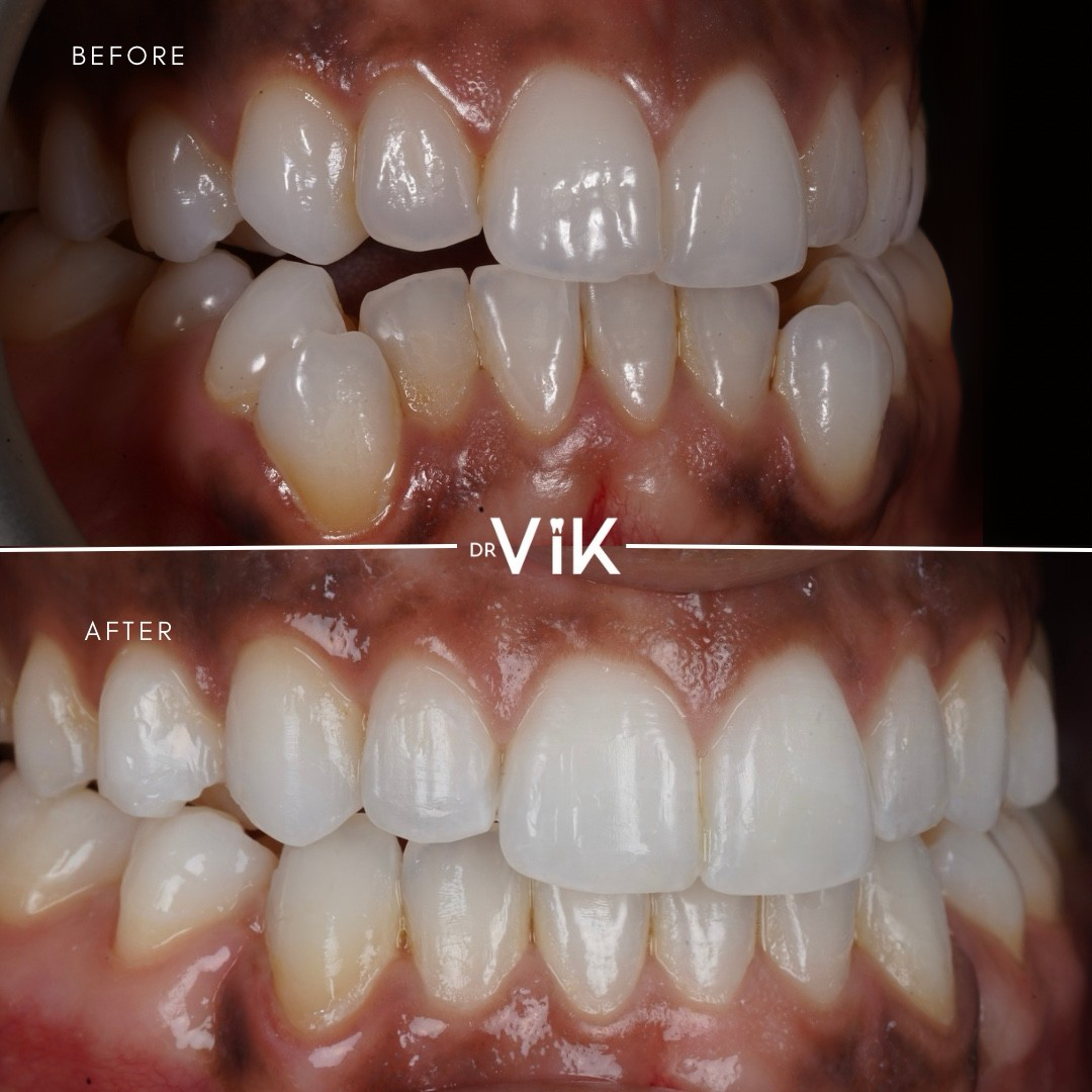 Invisalign case 9