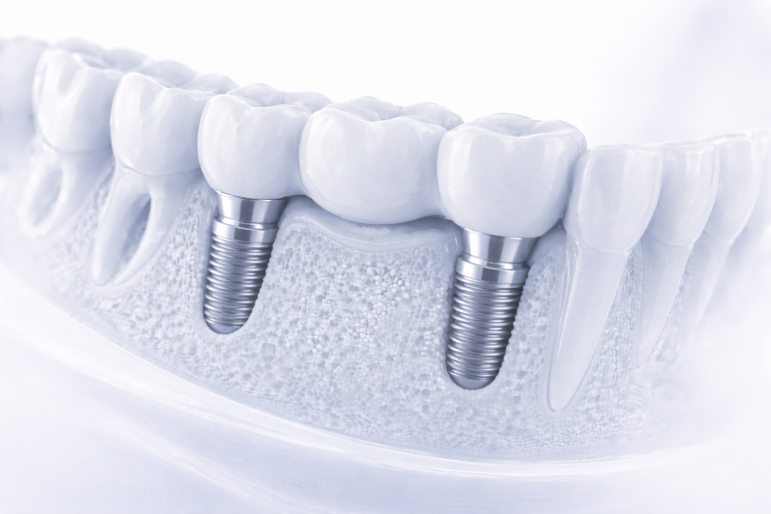 Implant-supported bridge spanning multiple teeth
