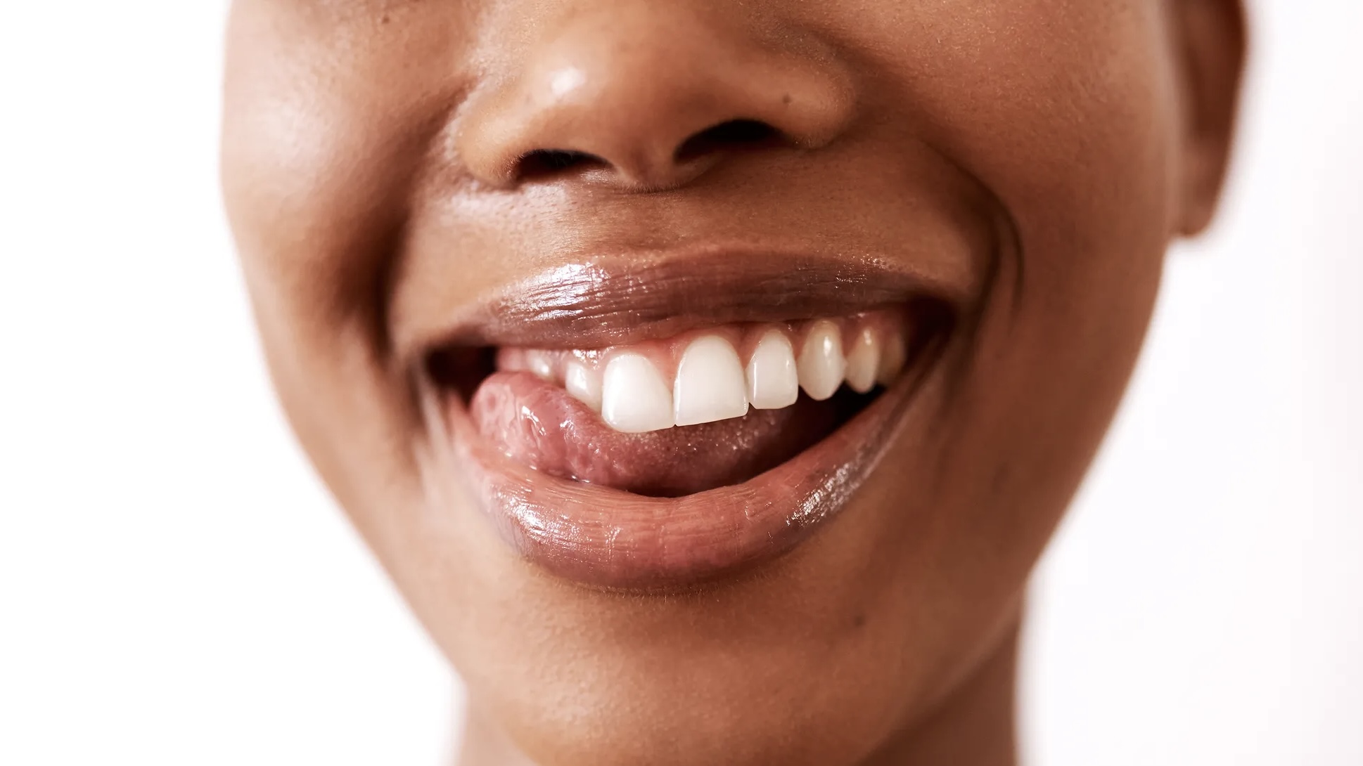 Complete smile makeover