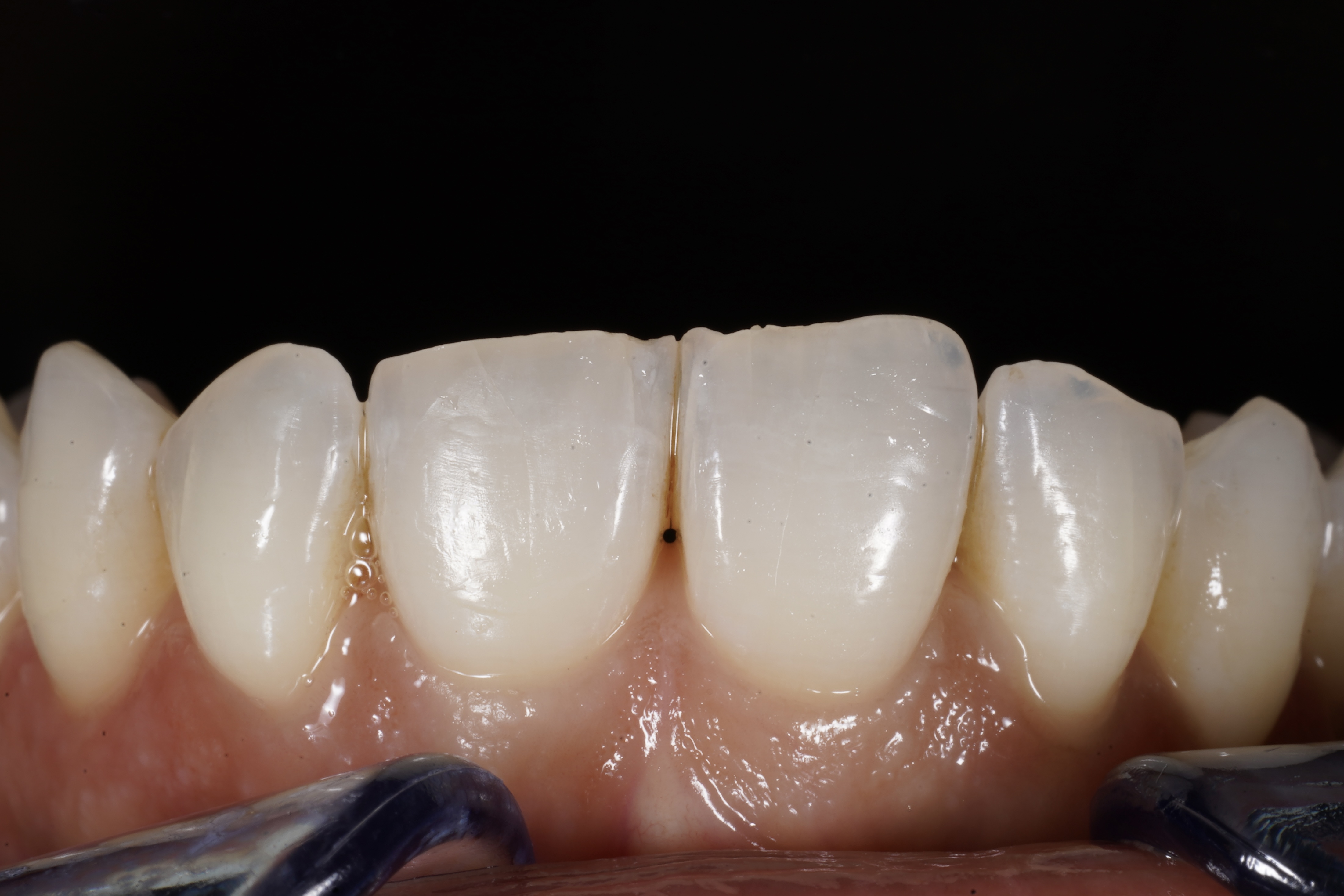 Composite bonding start view