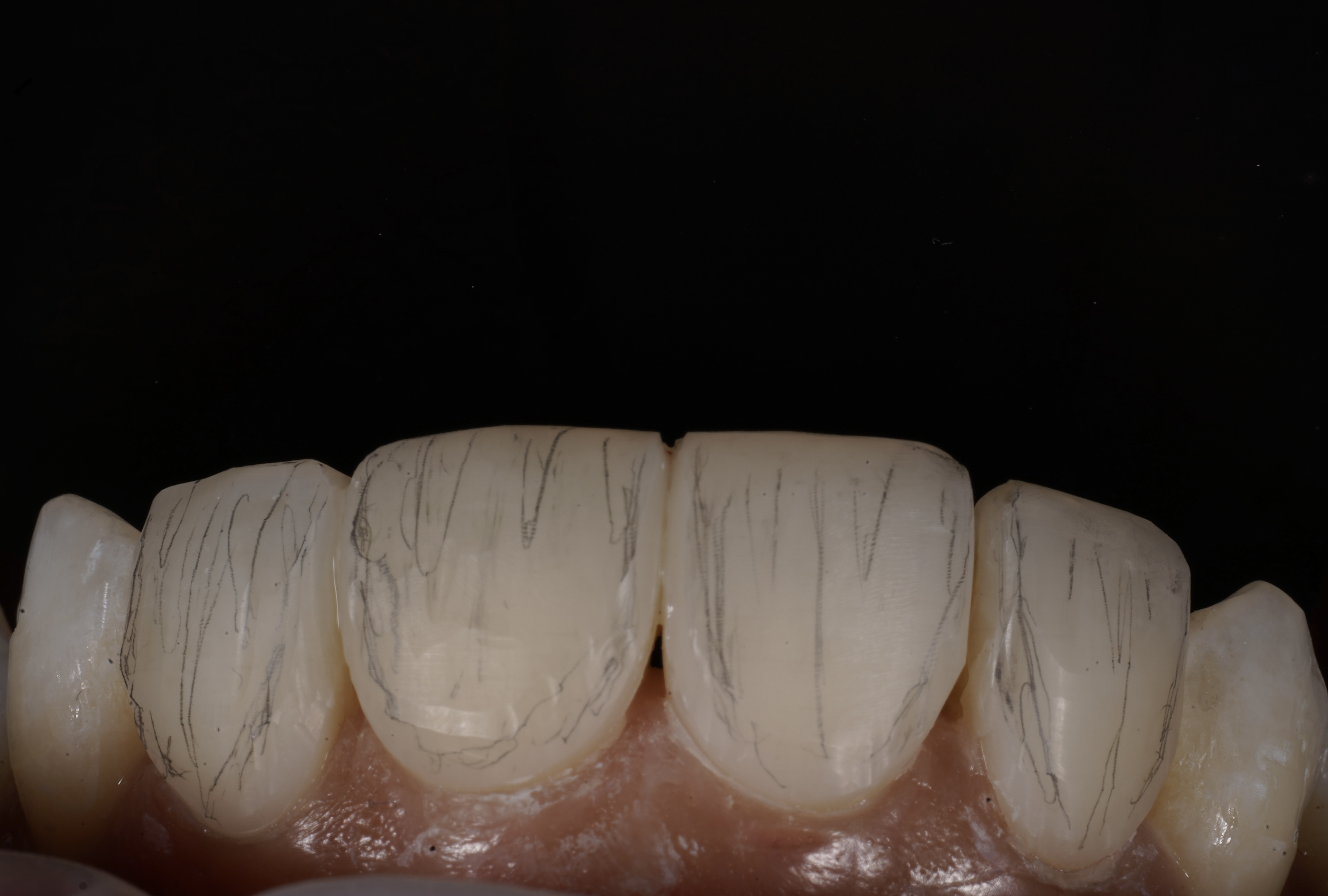 Composite bonding pencil marks for line angles and texture planning
