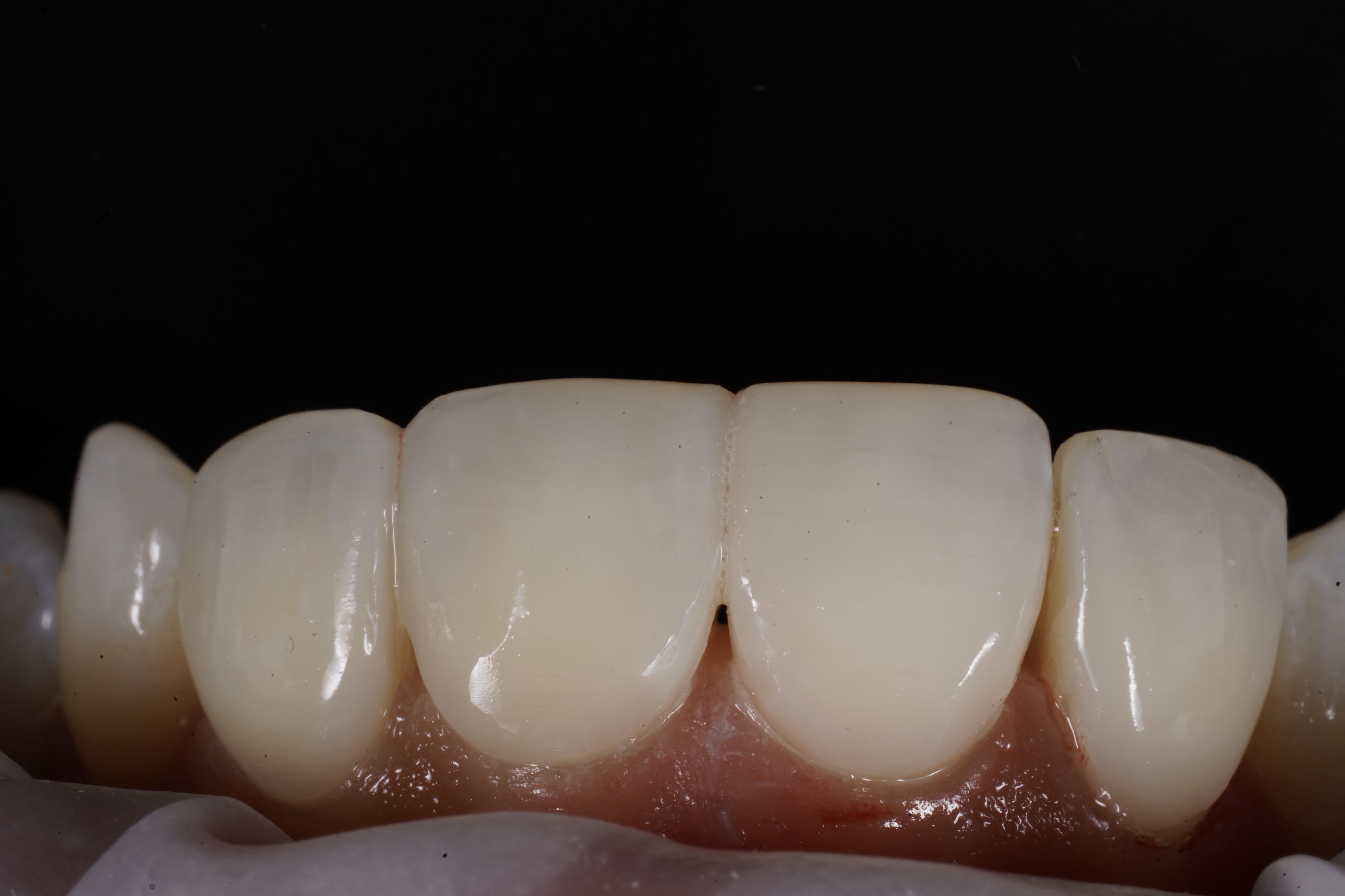 Composite bonding final polished result