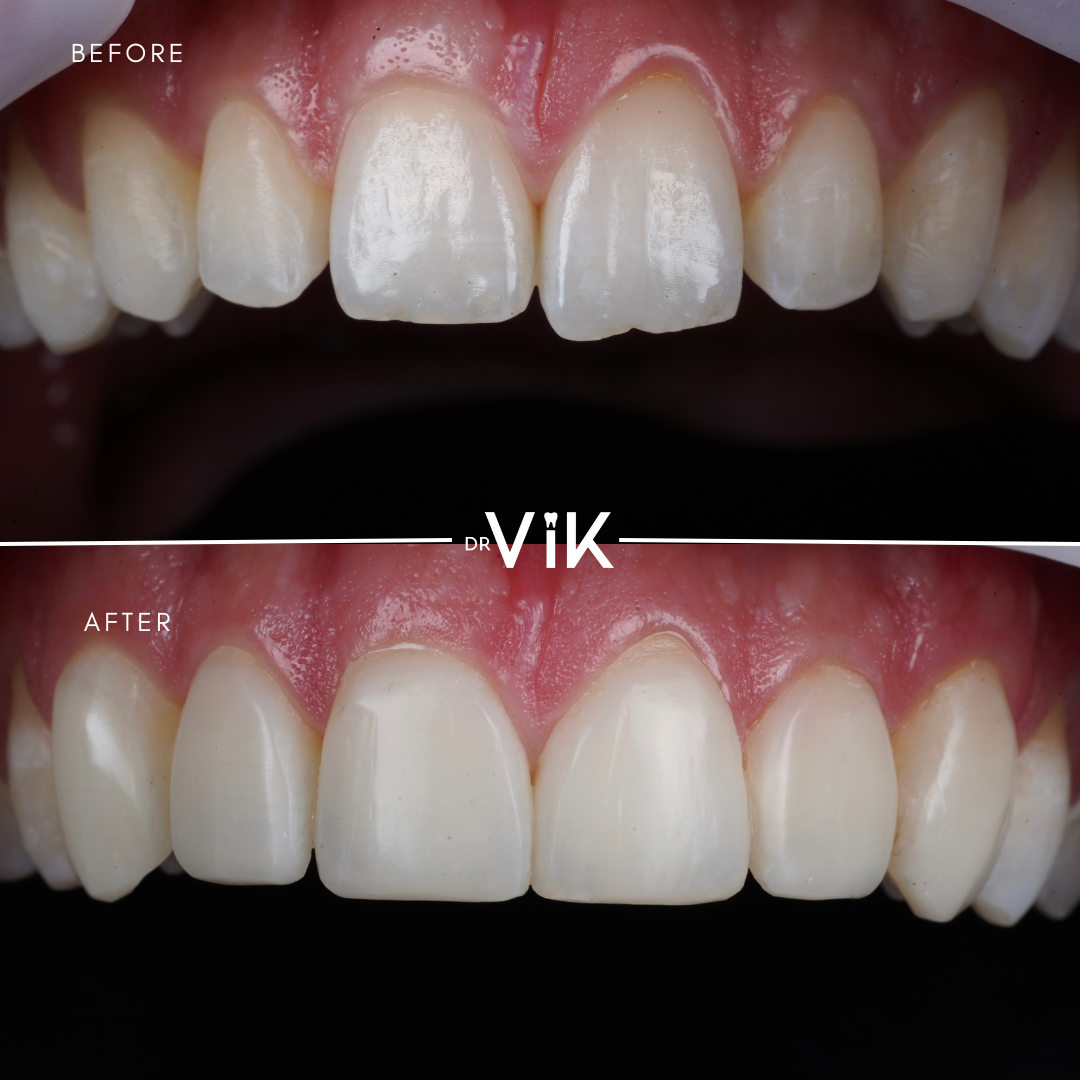 Composite bonding case 1