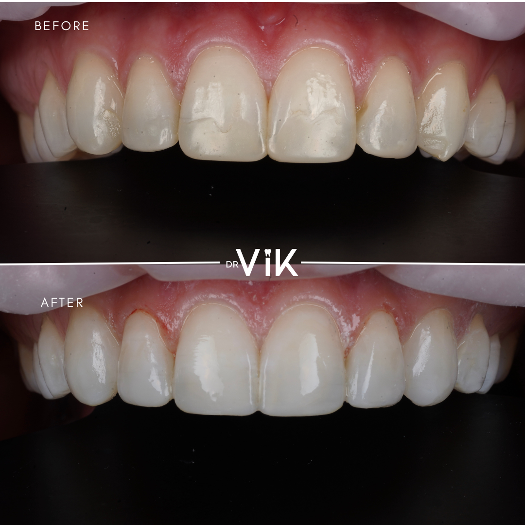 Composite bonding case 10