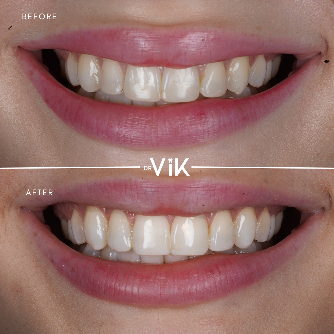 Composite bonding case 11