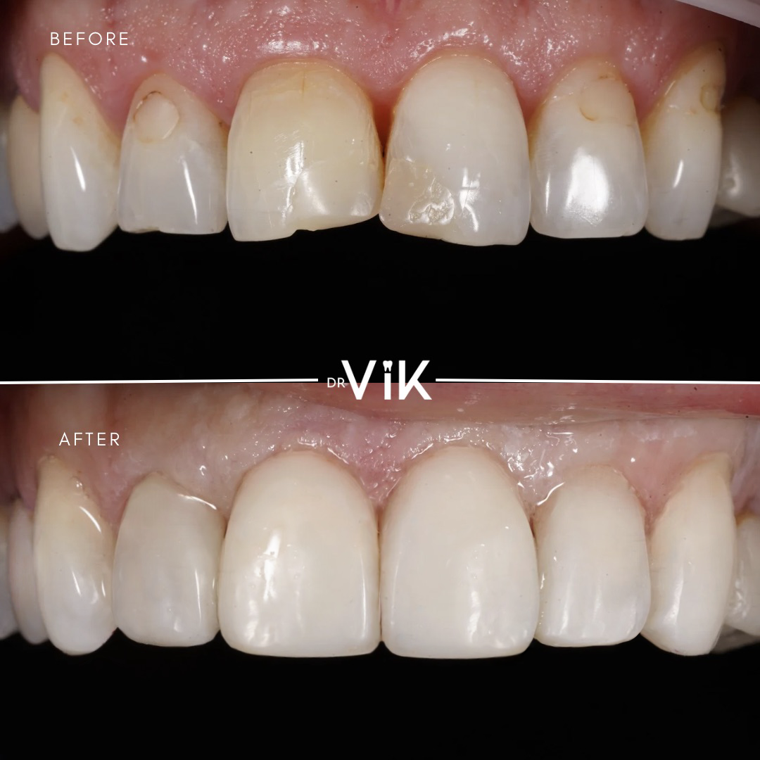 Composite bonding case 12