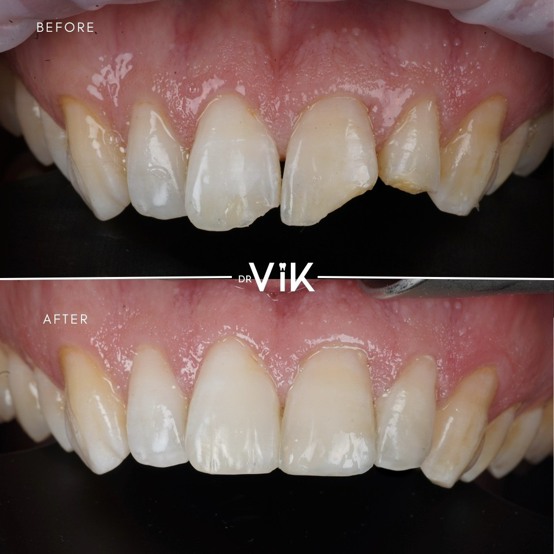 Composite bonding case 14