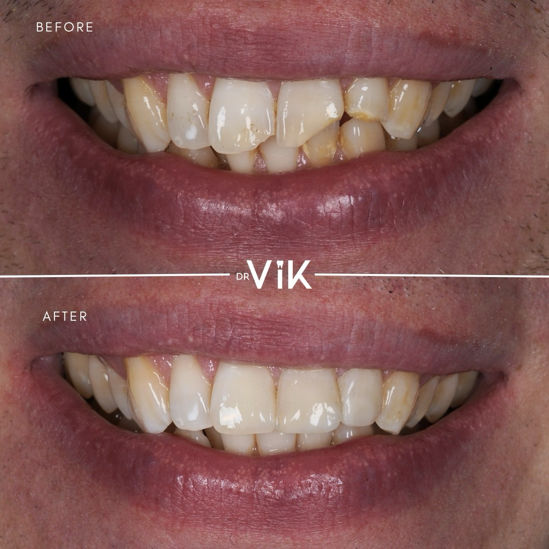 Composite bonding case 15