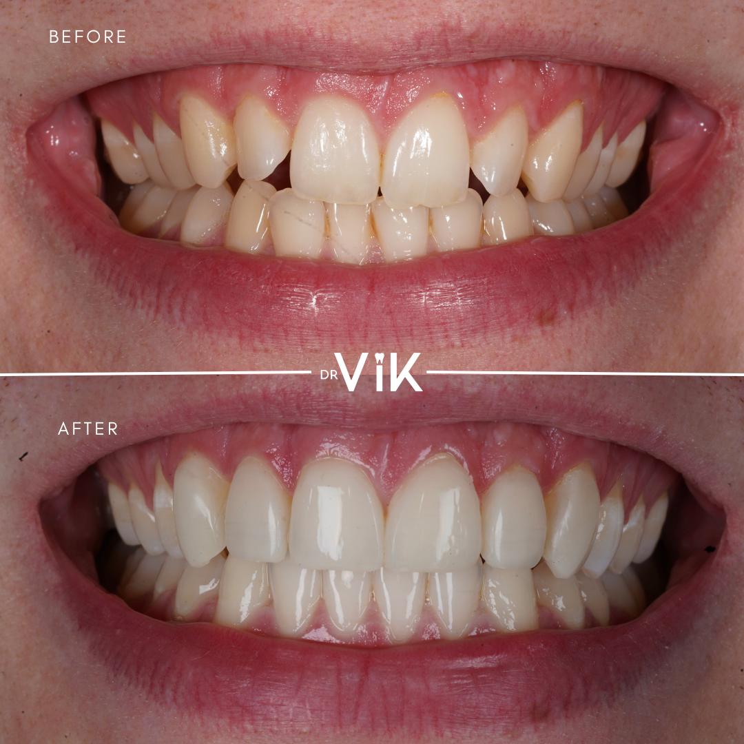 Composite bonding case 2