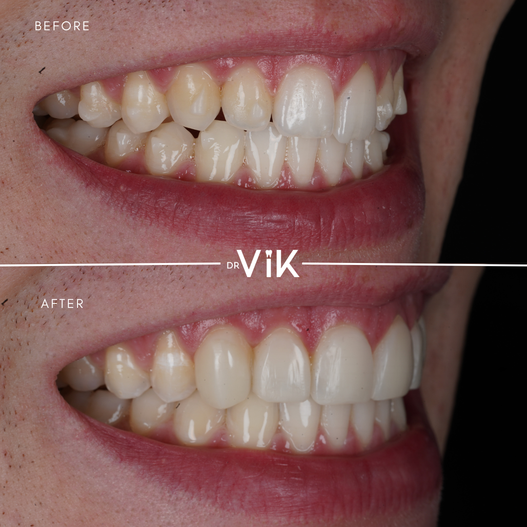 Composite bonding case 3