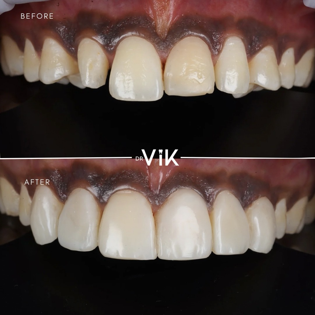 Composite bonding case 4