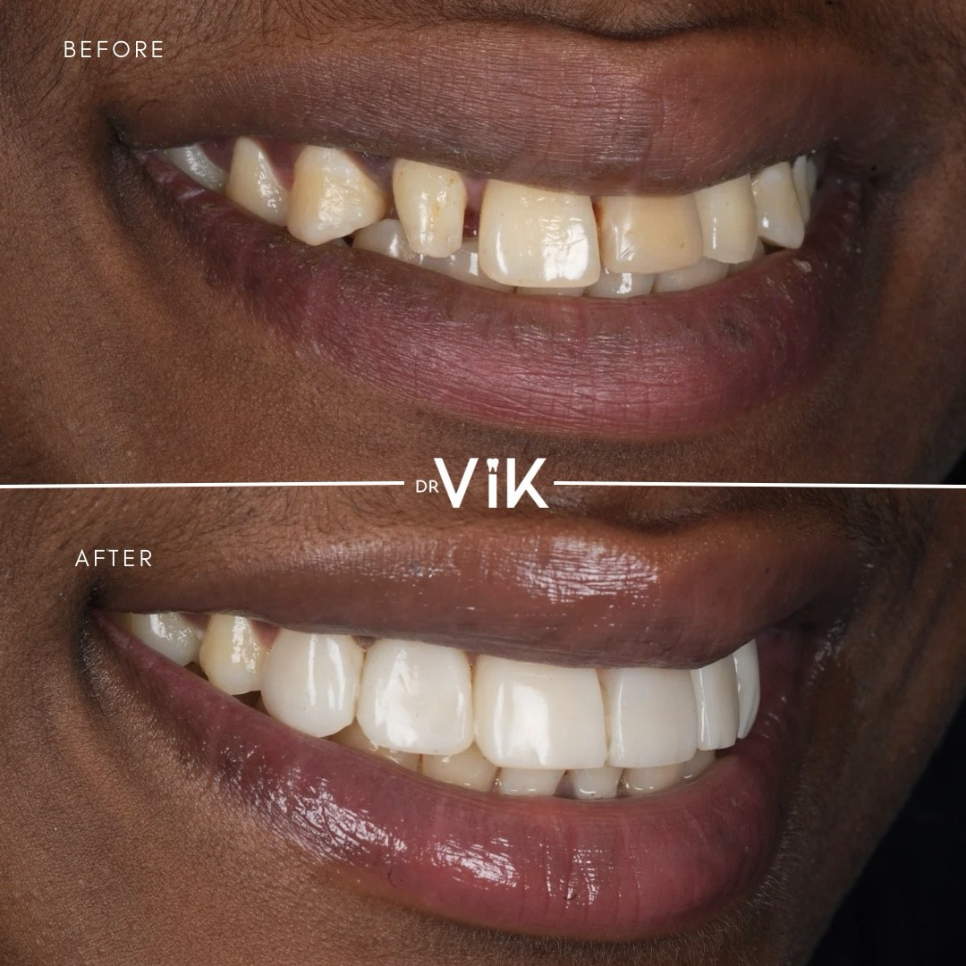 Composite bonding case 5