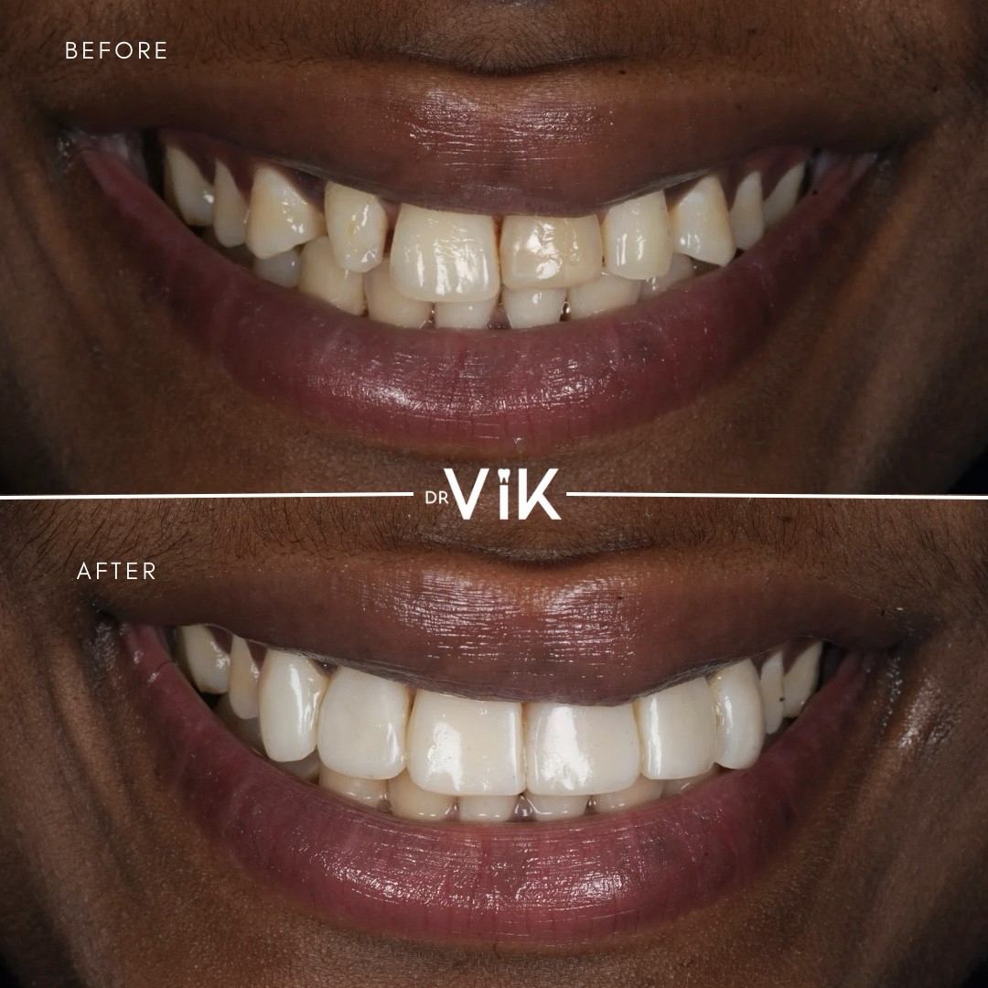 Composite bonding case 6