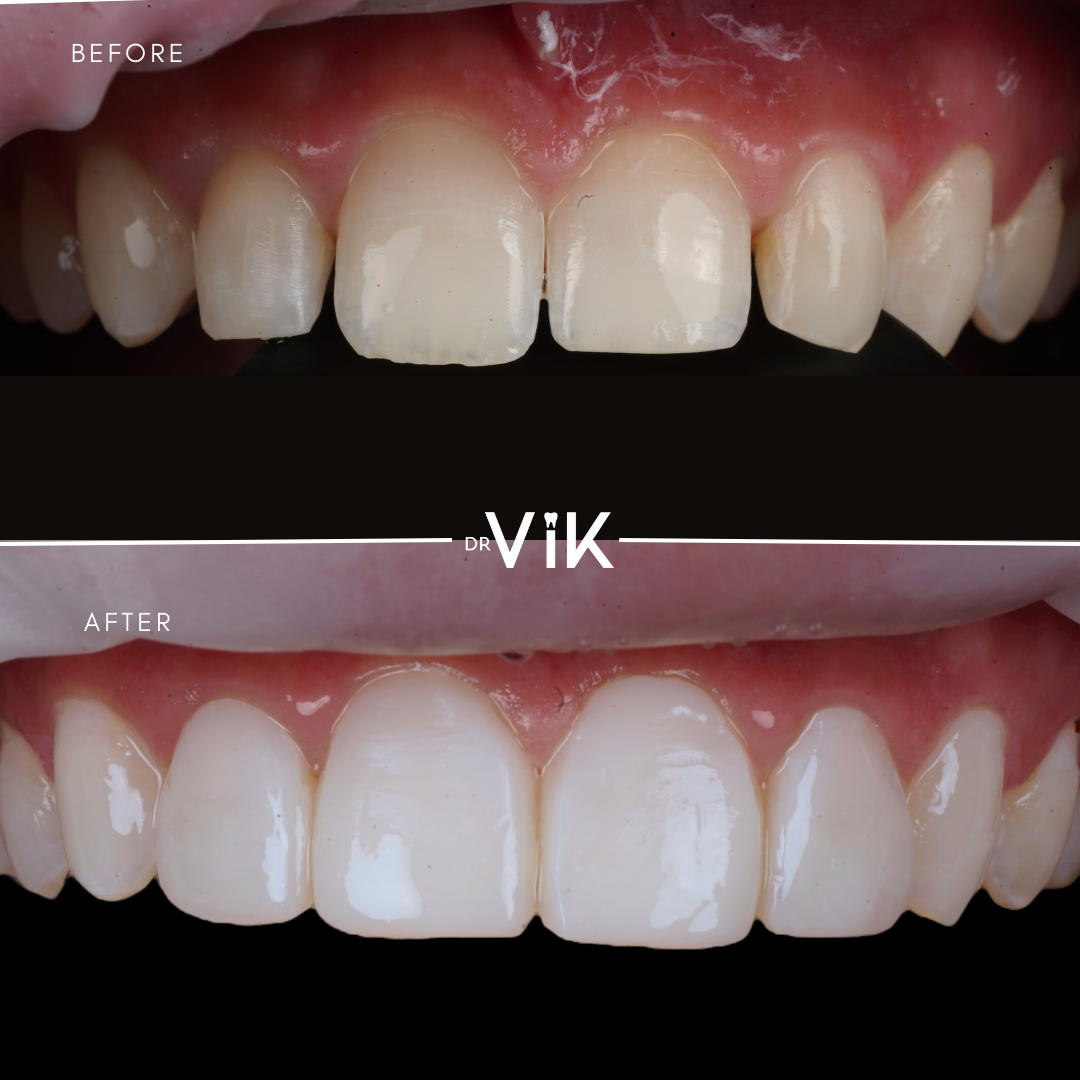 Composite bonding case 7