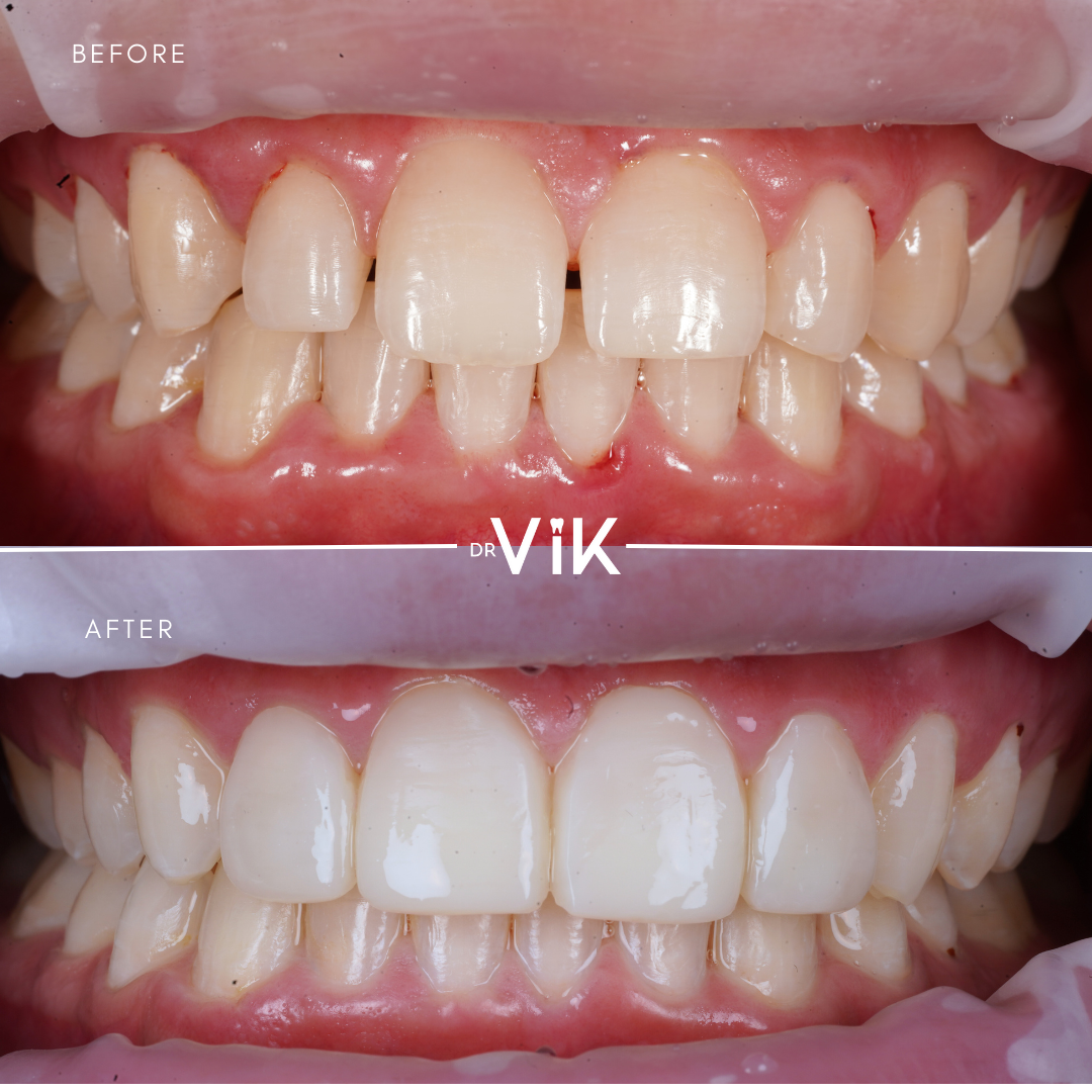Composite bonding case 8