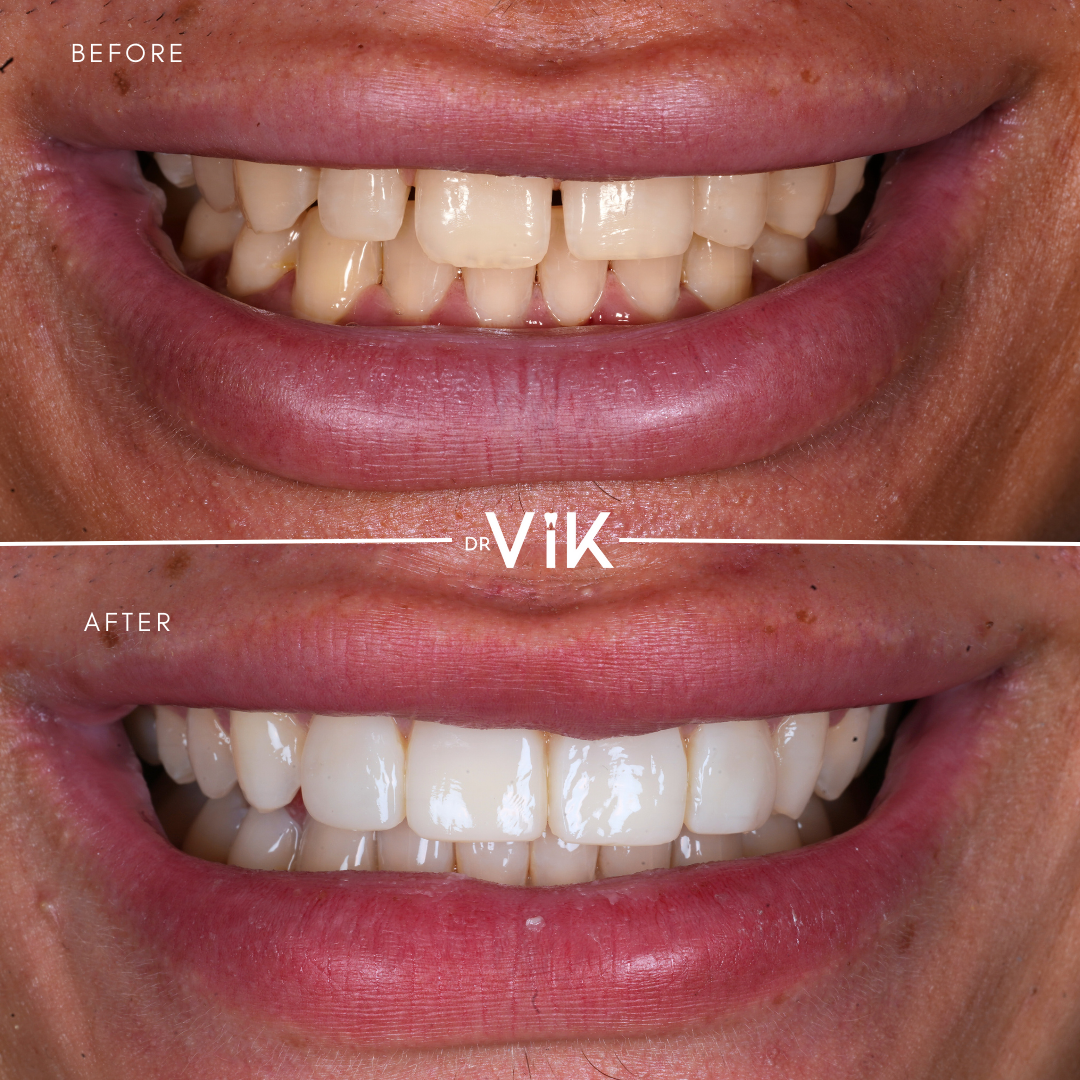 Composite bonding case 9
