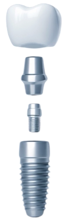 Exploded view of a dental implant