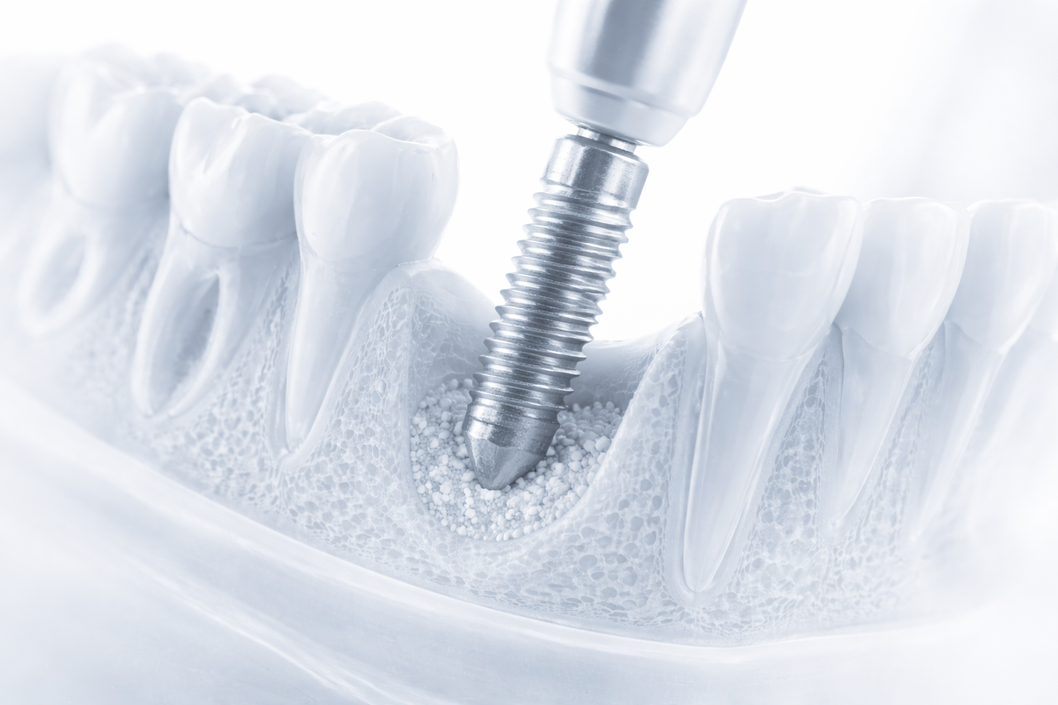 Implant fixture being placed into jawbone