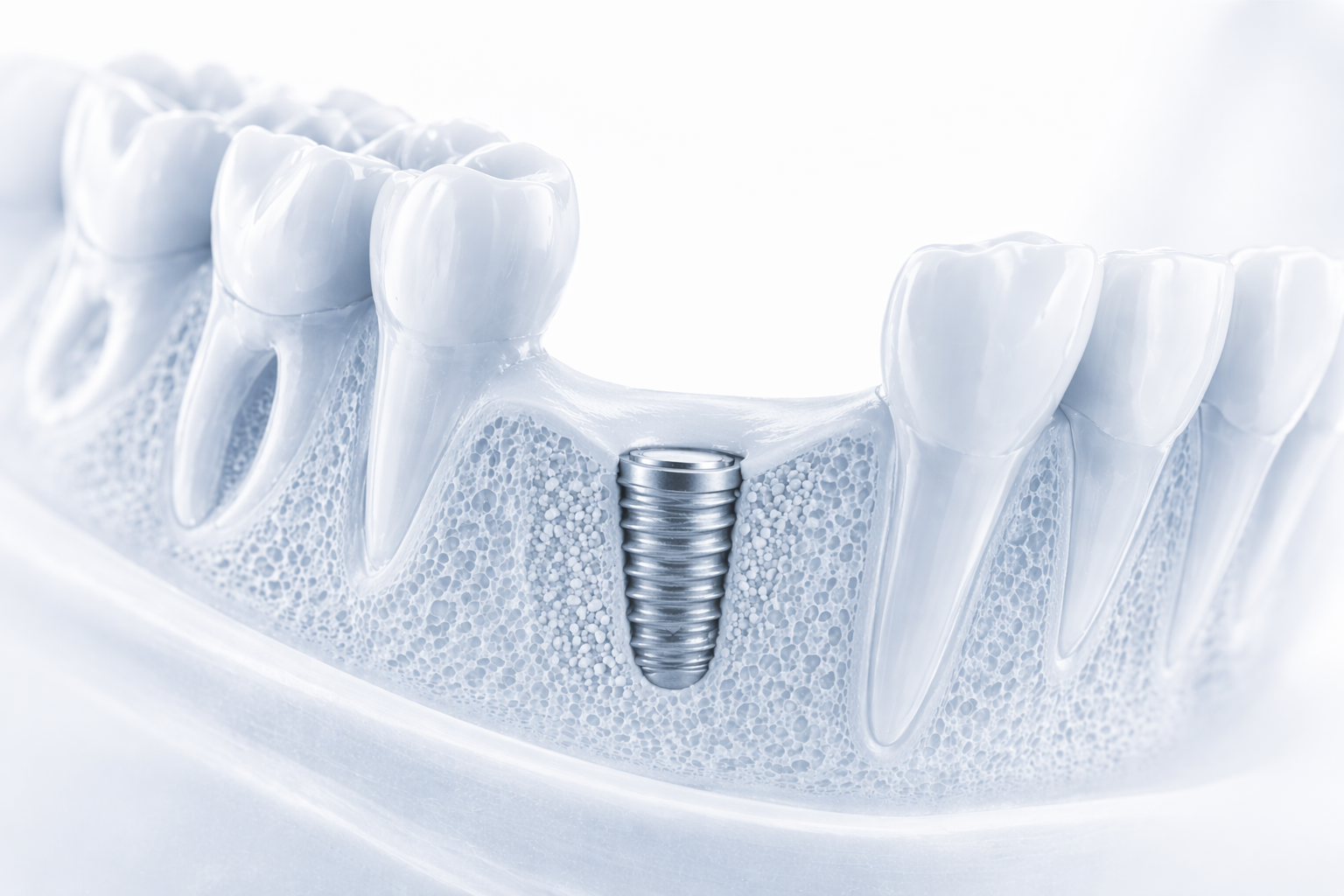 Implant fixture seated and integrating with bone
