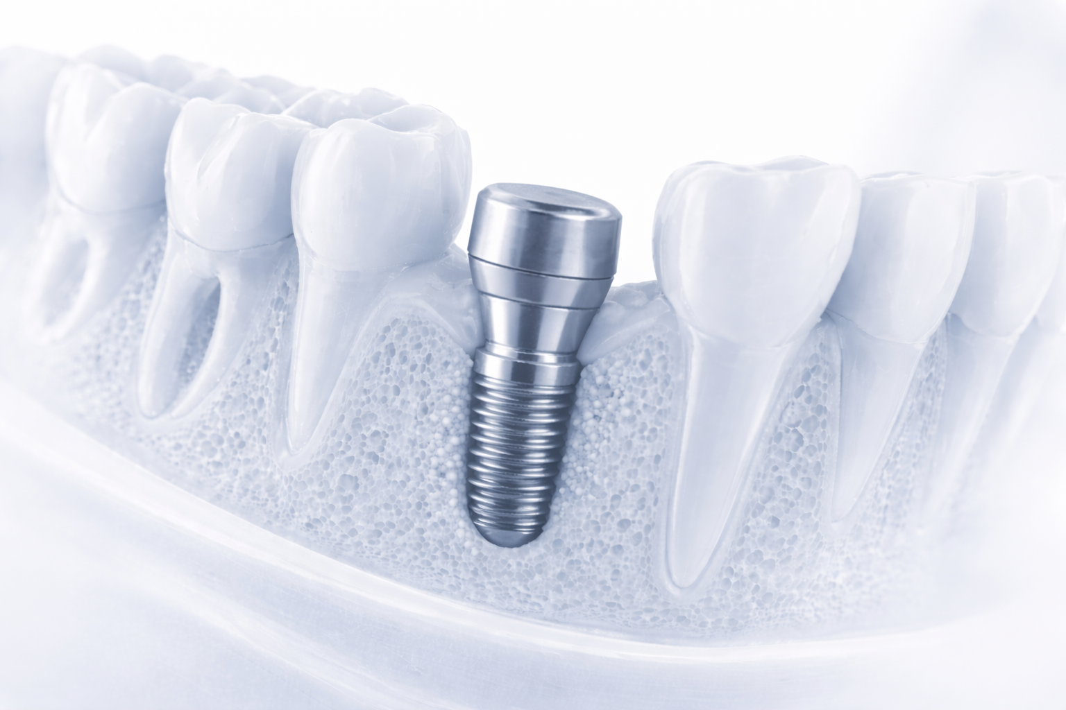 Abutment connector attached to implant