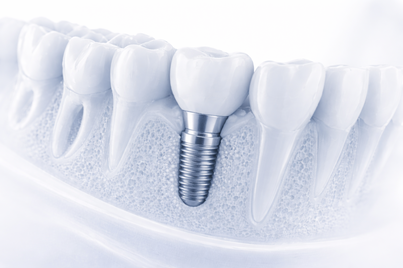 Final crown fitted onto implant