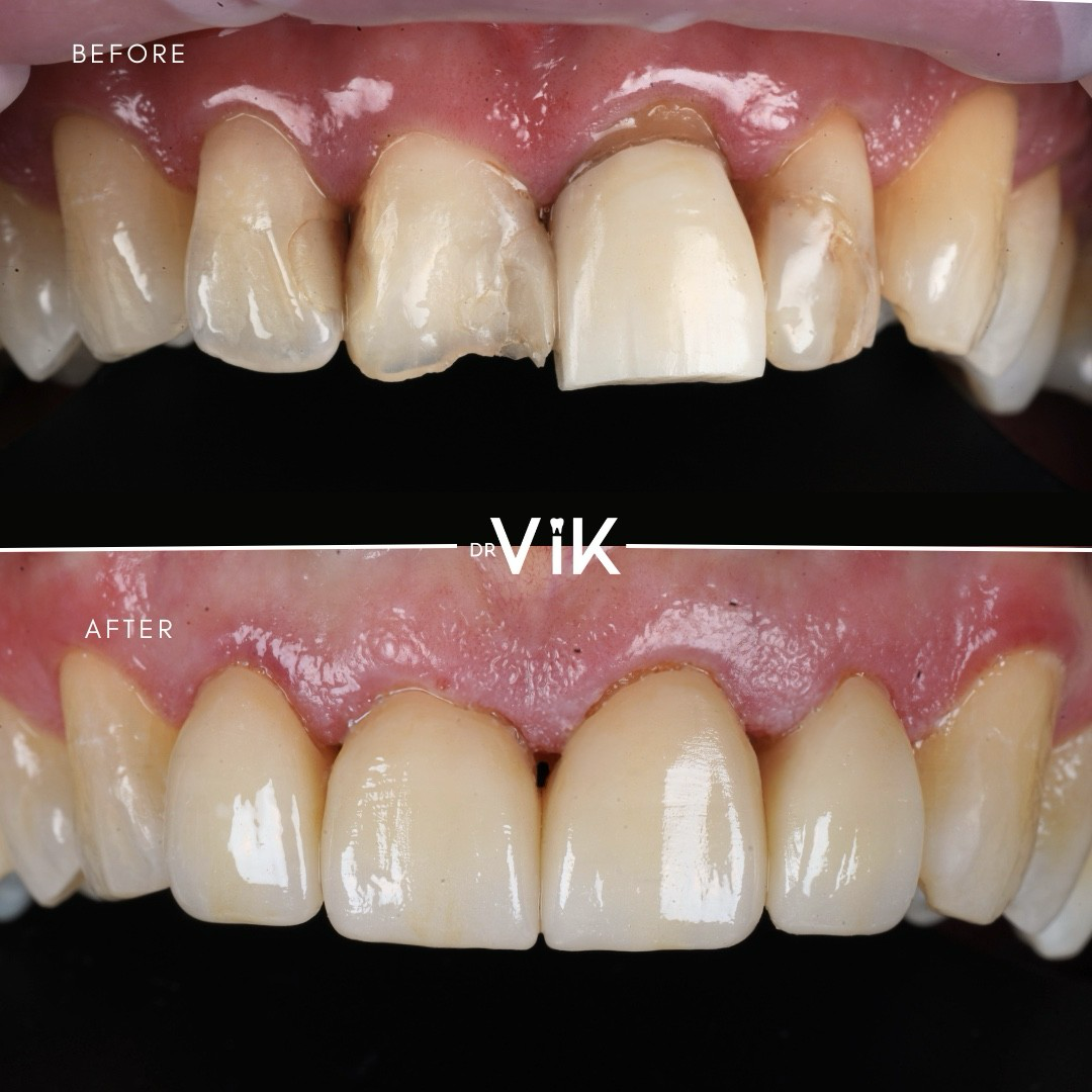 Porcelain veneers case 1