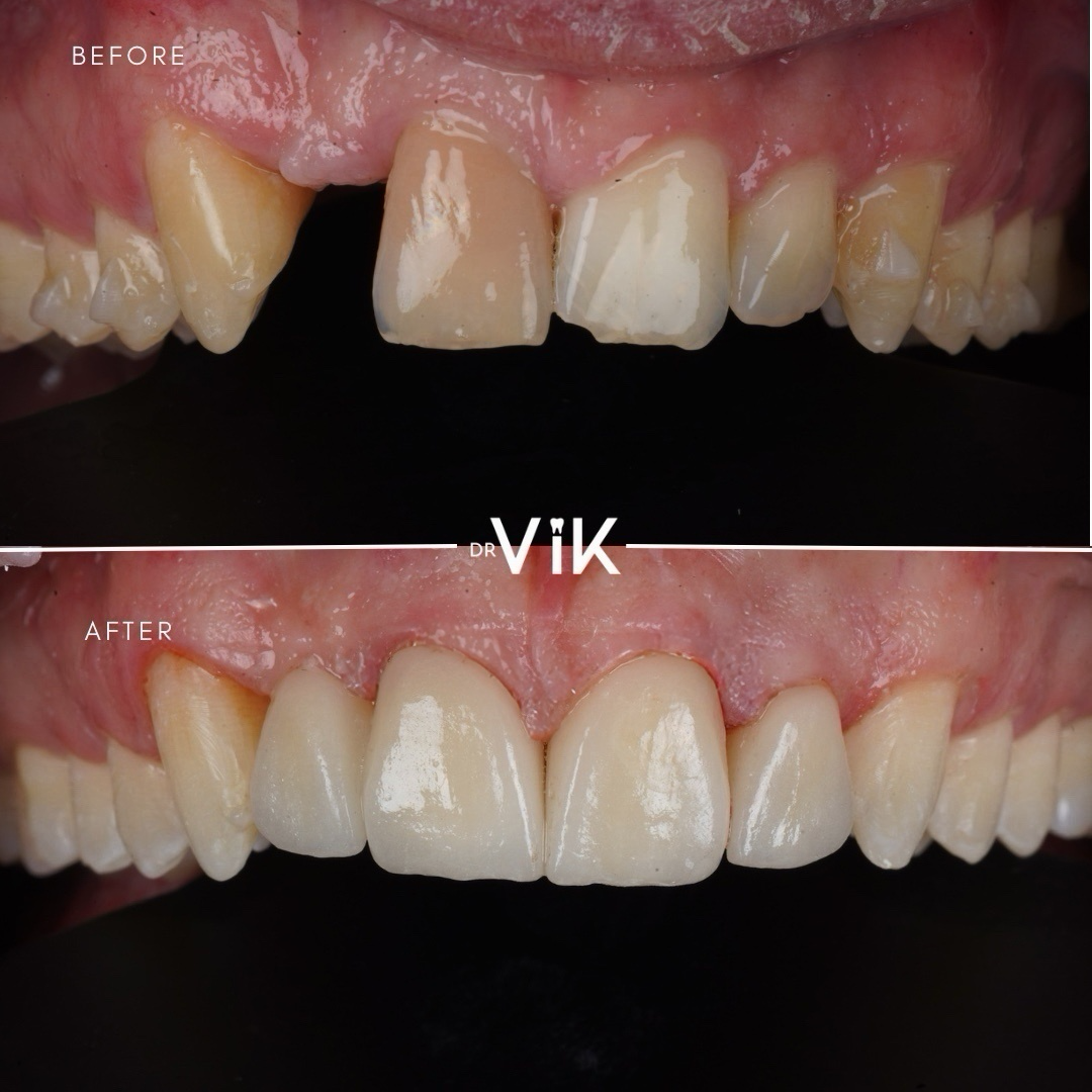 Porcelain veneers case 10