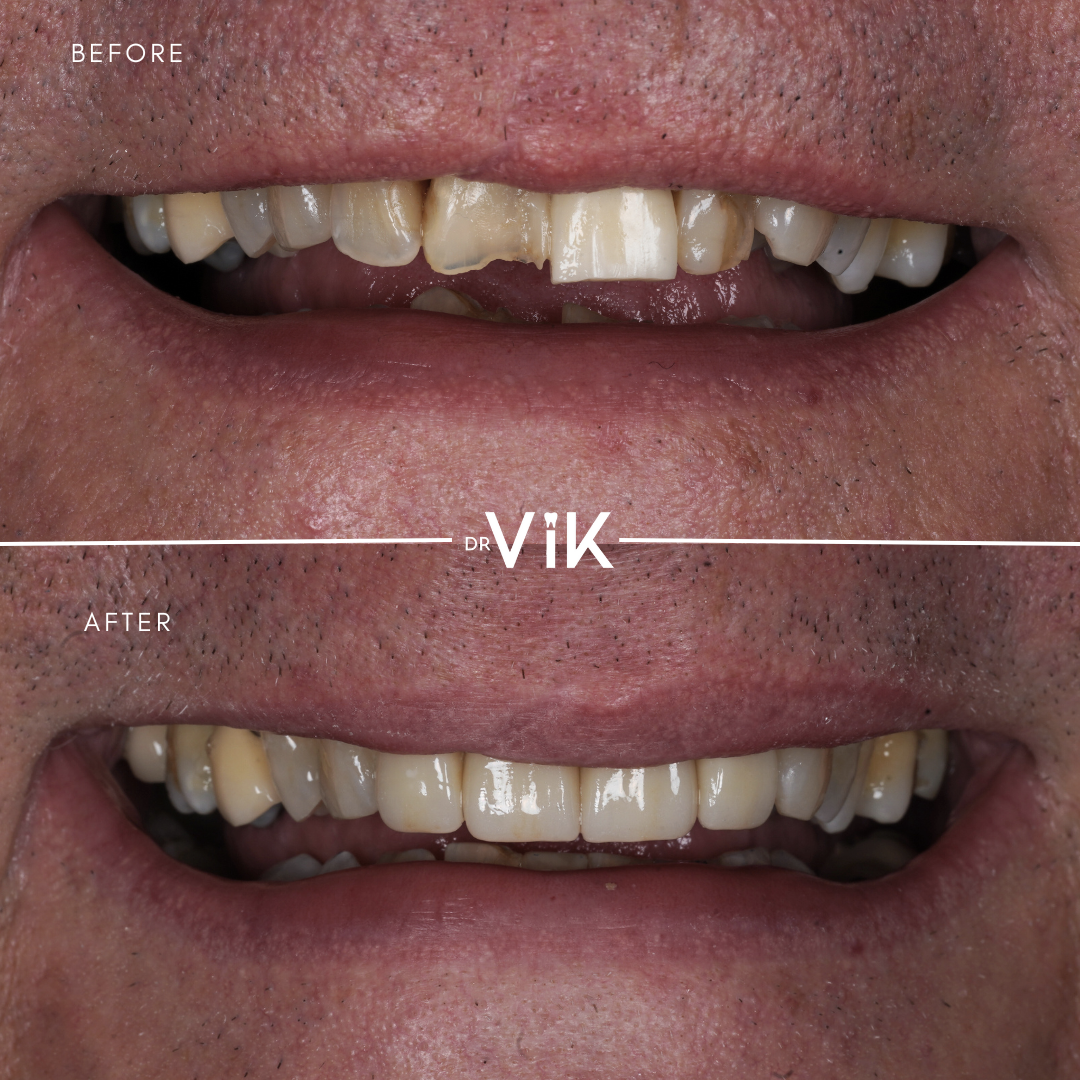 Porcelain veneers case 2