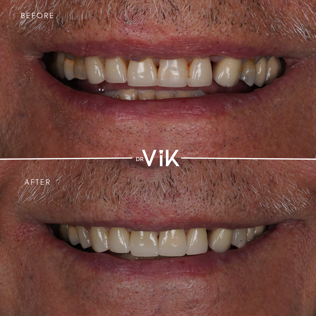 Porcelain veneers case 3