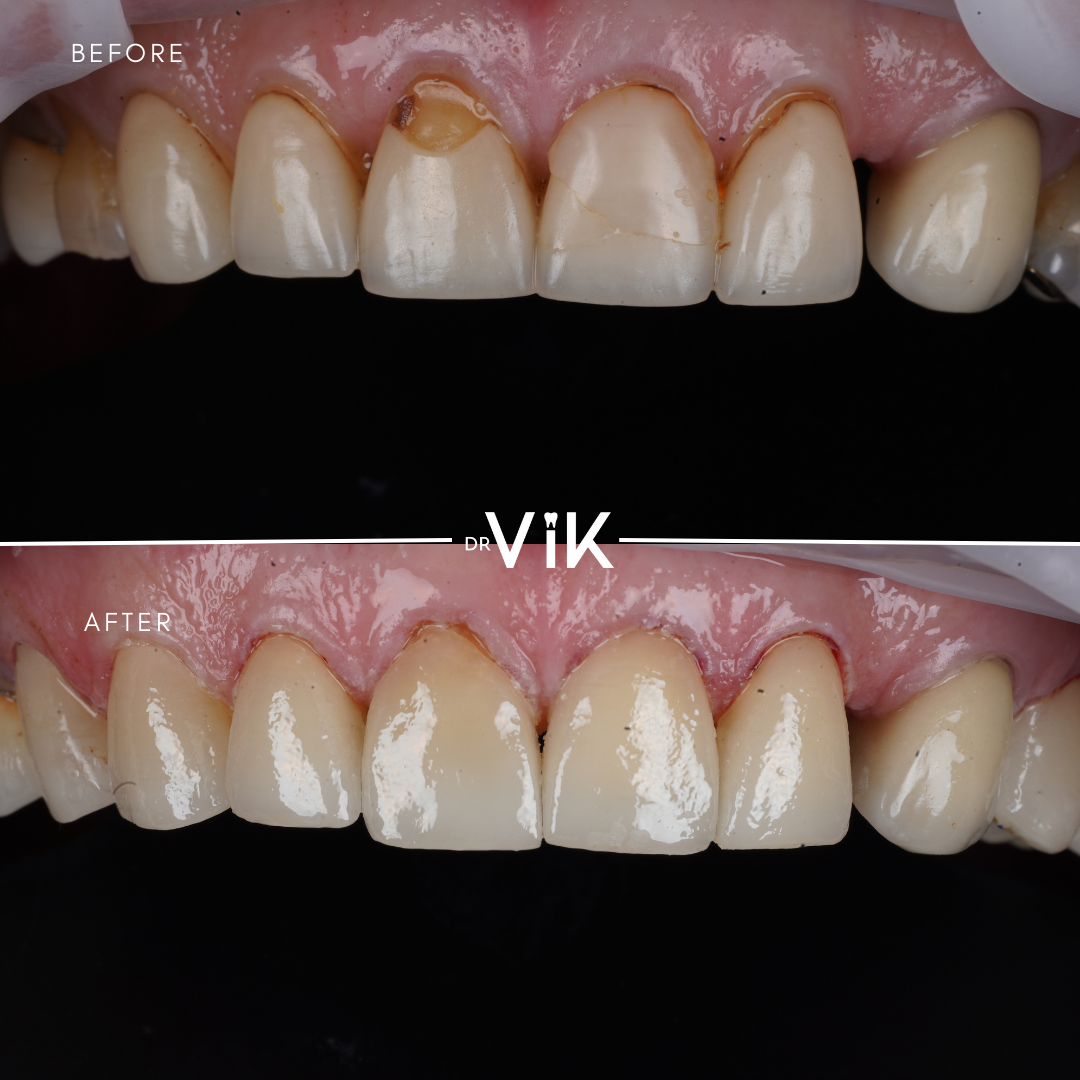 Porcelain veneers case 4