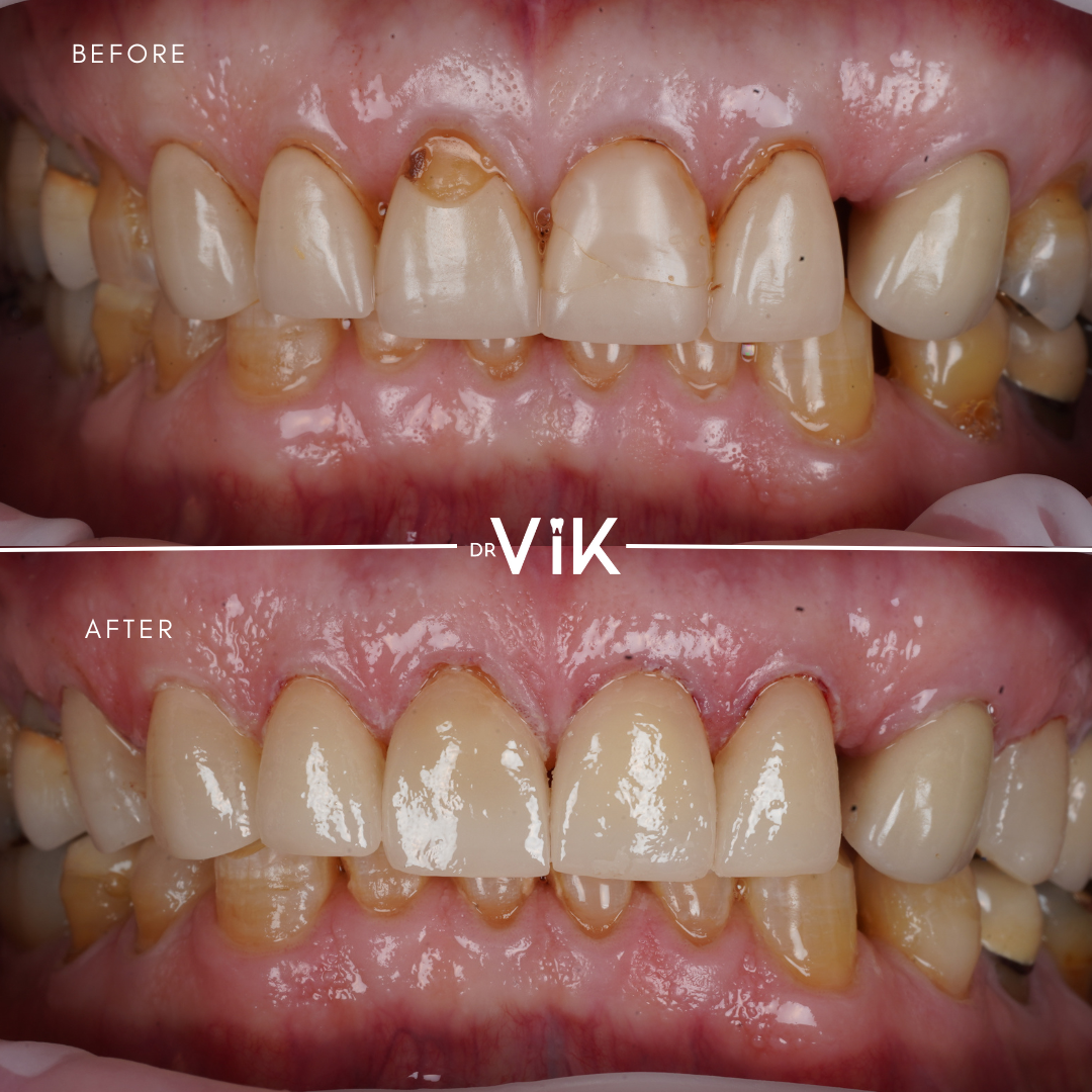 Porcelain veneers case 5