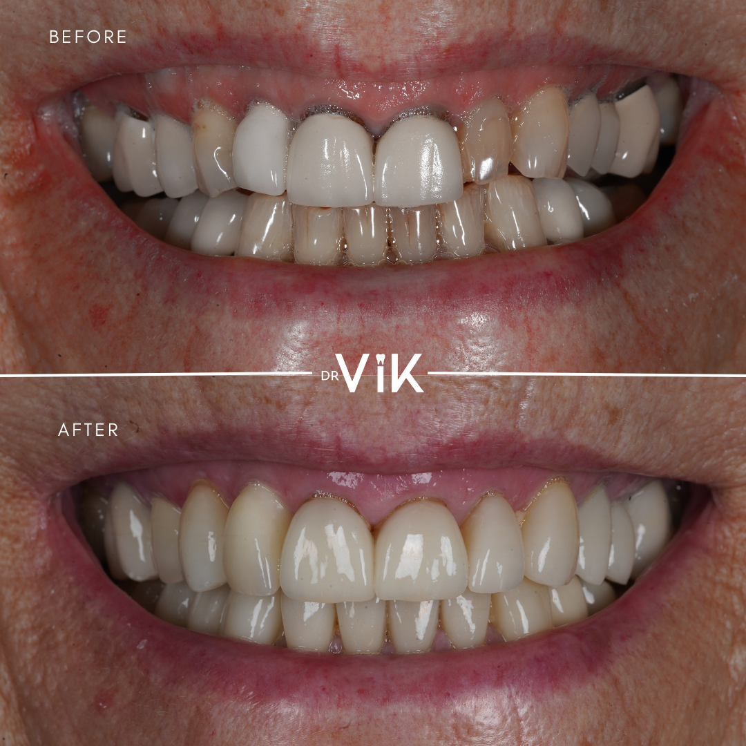Porcelain veneers case 6