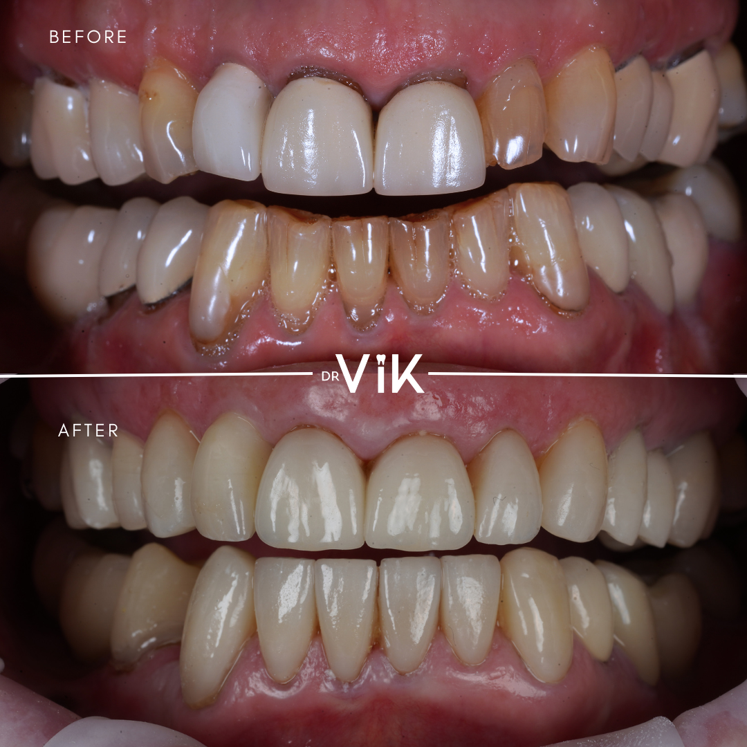 Porcelain veneers case 7