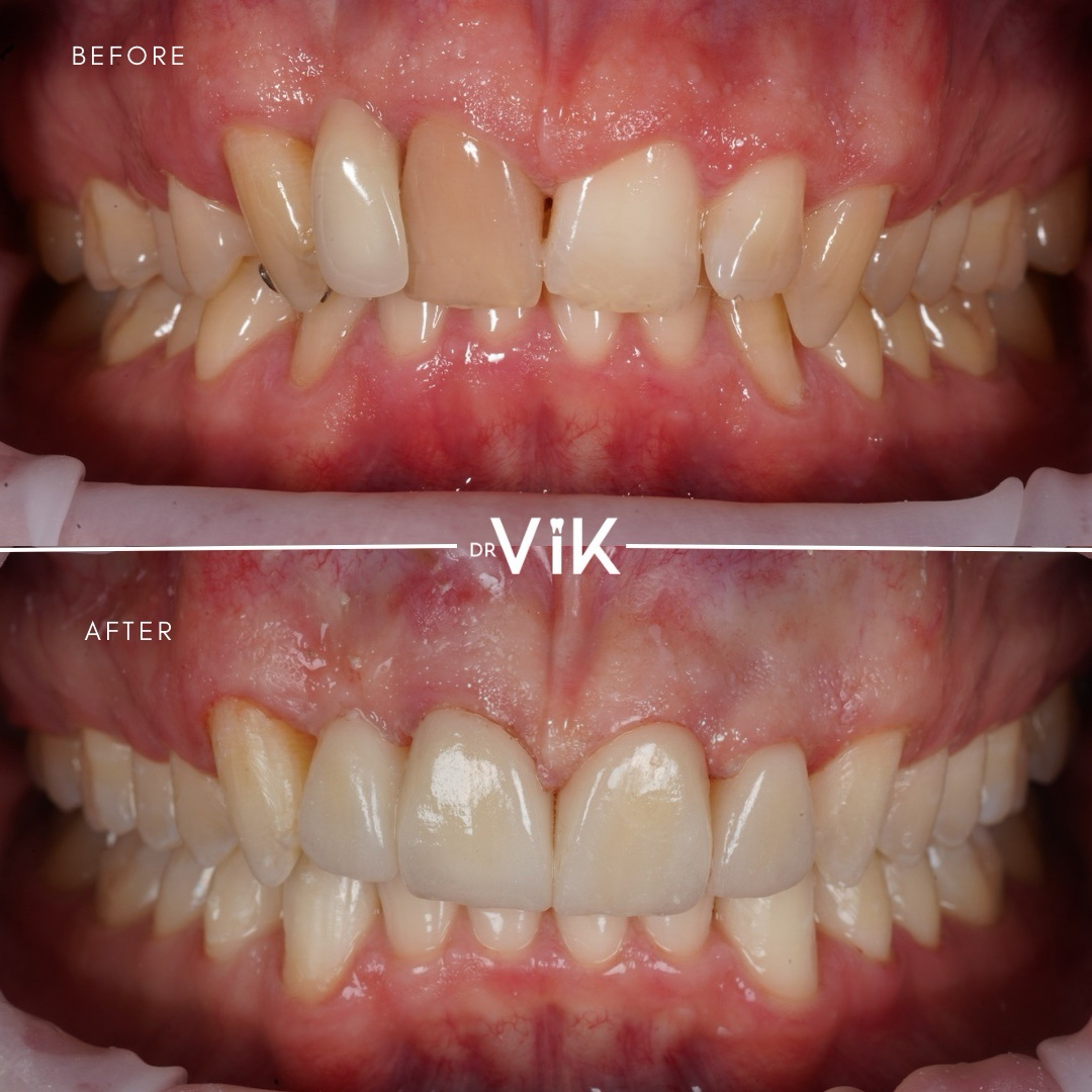 Porcelain veneers case 8