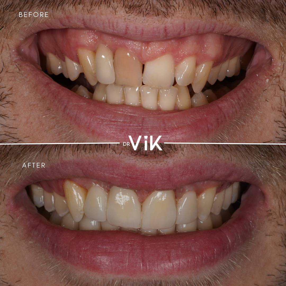 Porcelain veneers case 9